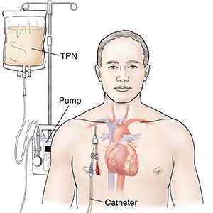 Diagram of TPN pump and catheter